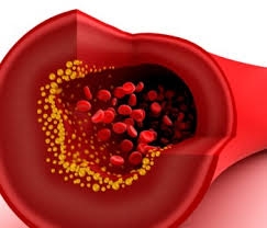 تصلب شرایین چیست ؟