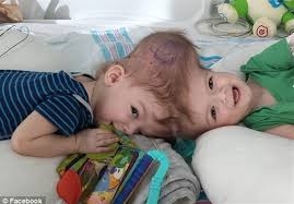 جراحي موفق دوقلوي بهم چسبيده 13 ماهه