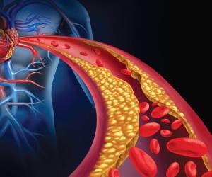 خطرات بالا بودن چربی خون و درمان آن