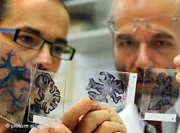 افزایش امیدها به تشخیص زود هنگام بیماری آلزایمر