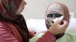 اسید پاشی بر روی زنان میهنمان، نماد بربریت رژیم آخوندی