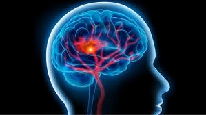 سن سكته مغزي در ايران ۱۰ سال كمتر از ميانگين جهاني است